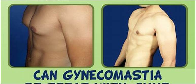 Exercises for gynecomastia treatment